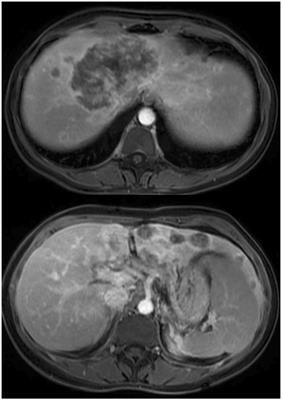 The role of living donor liver transplantation in treating intrahepatic cholangiocarcinoma